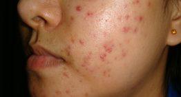 How you can Eliminate Acne Scarring During London?