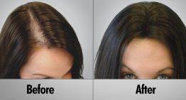 Guide to Choosing a Hair Loss Treatment Solution