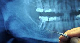 All You Need to Know about Root Canals