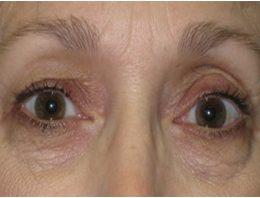 What Is The Average Recovery Time After Undergoing An Eyelid Surgery?