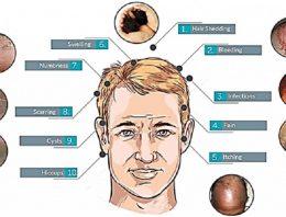 9 Possible Side Effects of  Hair Transplant  Surgery