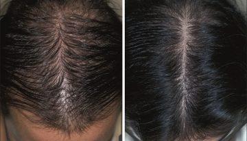 Propecia Treatment for Hair Loss