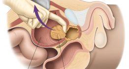 Things To Know When Thinking About Prostatectomy