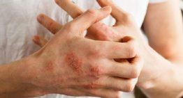 Stop that scratch – Treat Eczema!