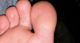 The natural treatment for warts