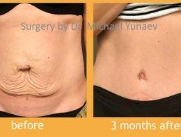 What You Need To Know About The Tummy Tuck Procedure