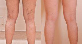 Is Spider Vein Treatment Worth the Cost?