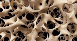 What is the best treatment for soft, brittle bones (osteoporosis)?