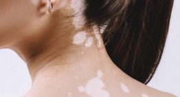 Vitiligo: Symptoms and treatment options