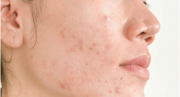 Surprising Causes of acne on the face