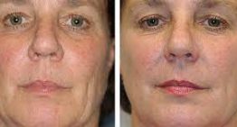 What Makes Thermage Different from Other Skin Tightening Treatments