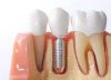 Factors to Consider Before Getting Dental Implants