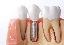 Factors to Consider Before Getting Dental Implants