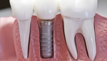 The Benefits of Dental Implants and Why You Might Need Them