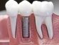 The Benefits of Dental Implants and Why You Might Need Them