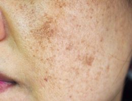 What are the Benefits of Pro Yellow Laser to the Skin