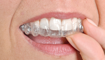 Everything You Need to Know About Teeth Straightening in Drexel Hill