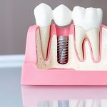 Dentures Vs Dental Implants – Which is the Right Tooth Replacement Solution for You?